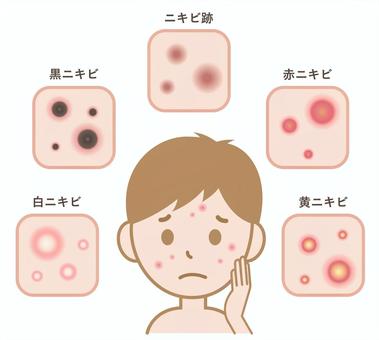 にきび
